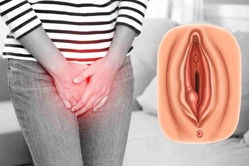 TÌM HIỂU VỀ BỆNH VIÊM TUYẾN BARTHOLIN 3 ap xe hinh anh viem tuyen bartholin
