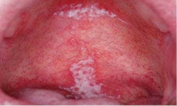 Hình ảnh bệnh lậu ở vòm họng