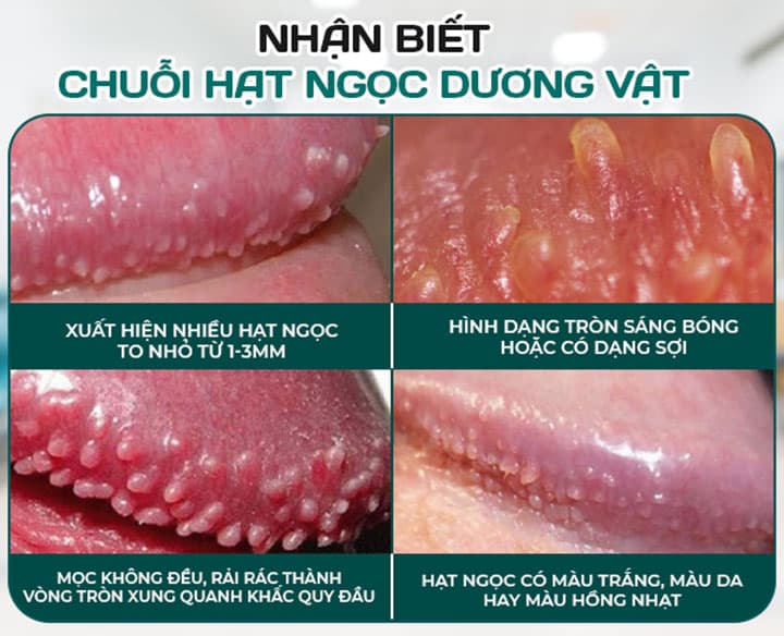 BAO QUY ĐẦU XUẤT HIỆN ĐỐM TRẮNG LÀ BỆNH GÌ ? 4 Chuỗi hạt ngọc dương vật
