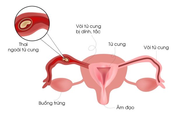 ĐAU BÊN PHẢI BỤNG DƯỚI Ở NỮ: BÁC SĨ CHỈ RÕ NGUYÊN NHÂN THƯỜNG GẶP 2 dau ben phai bung duoi1