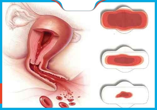 RONG KINH SAU KHI PHÁ THAI: NGUYÊN NHÂN & CÁCH XỬ LÝ AN TOÀN 3 dau hieu rong kinh sau khi pha thai