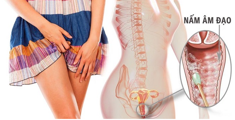 ĐAU RÁT VÙNG KÍN NỮ LÀ TRIỆU CHỨNG CỦA BỆNH GÌ? 2 Đau rát vùng kín do nấm âm đạo