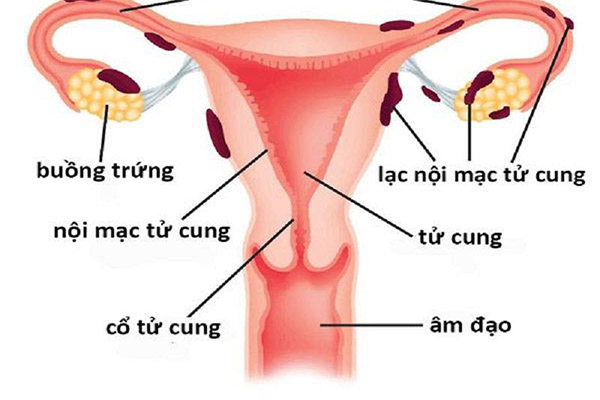 14 NGUYÊN NHÂN GÂY ĐAU BỤNG DƯỚI BÊN TRÁI Ở NỮ 3 lac noi mac tu cung 1