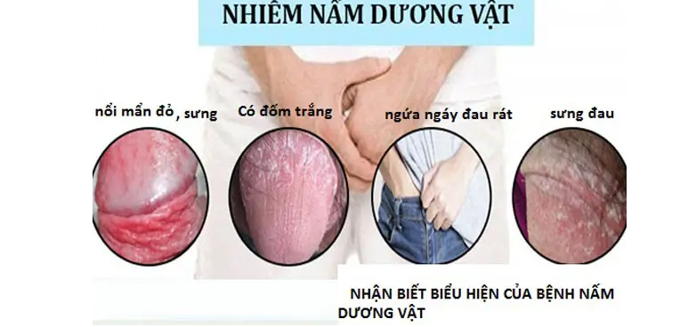 NẤM CANDIDA Ở ĐẦU DƯƠNG VẬT: NGUYÊN NHÂN, DẤU HIỆU & CÁCH ĐIỀU TRỊ 2 nam dv