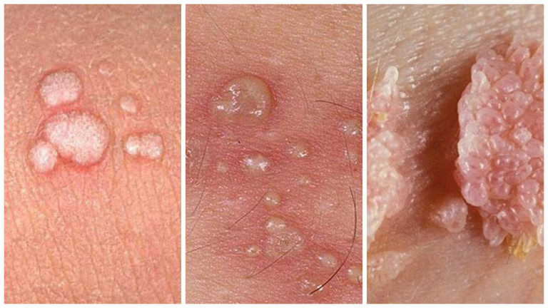 BAO QUY ĐẦU XUẤT HIỆN ĐỐM TRẮNG LÀ BỆNH GÌ ? 3 Bao quy đầu xuất hiện đốm trắng do mụn sùi mào gà