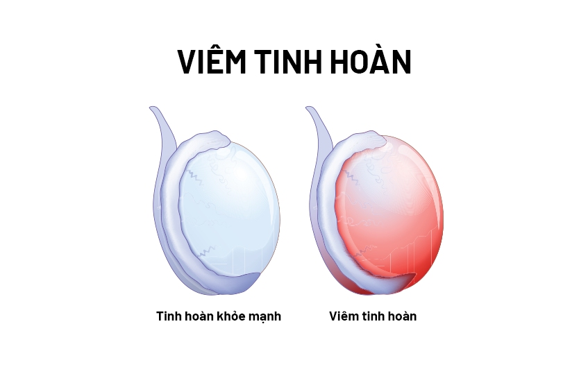 ĐAU TINH HOÀN LÀ MẮC BỆNH GÌ? 2 sung dau tinh hoan do viem tinh hoan