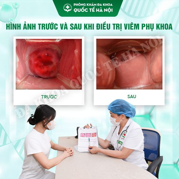 PHÒNG KHÁM CHỮA KHÍ HƯ BẤT THƯỜNG UY TÍN - KHÁM NHANH, ĐIỀU TRỊ HIỆU QUẢ 5 trc sau dtri viem phu khoa