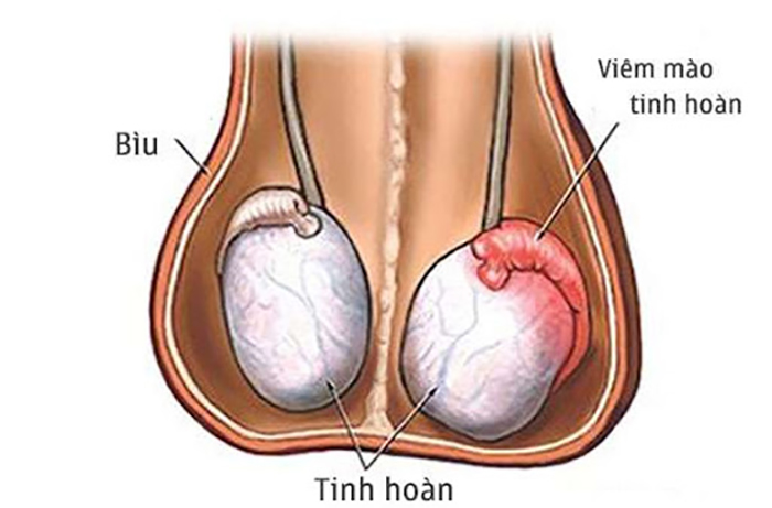 viem mao tinh hoan gay sung dau tinh hoan