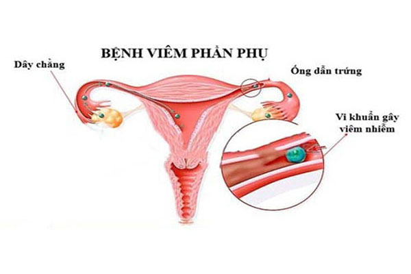 KHÍ HƯ CÓ MÀU TRẮNG: NGUYÊN NHÂN VÀ CÁCH ĐIỀU TRỊ 6 viem phan phu