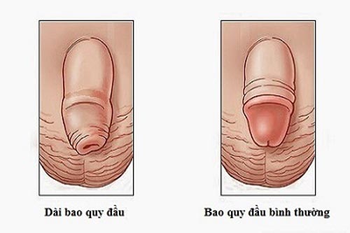 DÀI BAO QUY ĐẦU GIẢ LÀ GÌ? CÓ CẦN CẮT KHÔNG? 1 dai bao quy dau 4