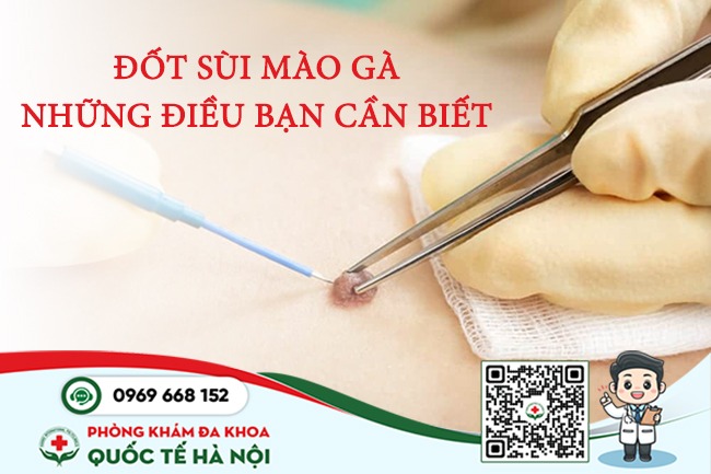 đốt sùi mào gà