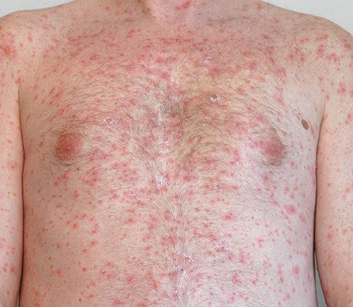 BỆNH GIANG MAI Ở NAM GIỚI 2 giang mai giai doan 2