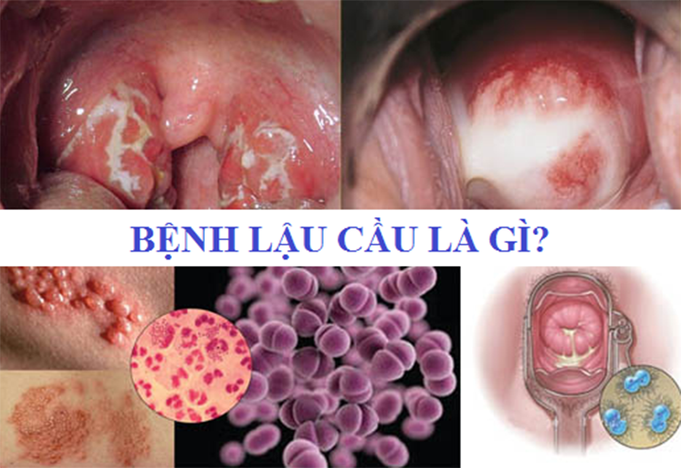 RA KHÍ HƯ MÀU VÀNG: NGUYÊN NHÂN VÀ CÁCH CHỮA 3 Bệnh lậu gây khí hư màu vàng