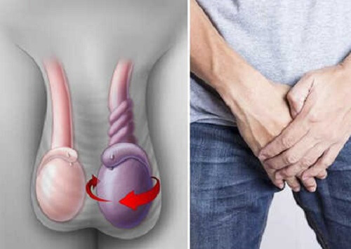 ĐAU TINH HOÀN BÊN PHẢI: NGUYÊN NHÂN, TRIỆU CHỨNG & CÁCH ĐIỀU TRỊ 3 Xoắn tinh hoàn - Nguyên nhân gây đau tinh hoàn bên phải