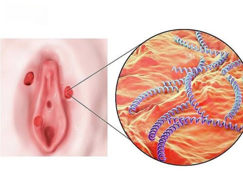 trieu chung benh giang mai