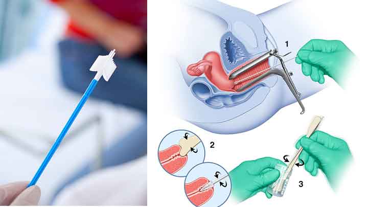 XÉT NGHIỆM PAP LÀ GÌ? KHI NÀO NÊN LÀM VÀ ĐỊA CHỈ XÉT NGHIỆM UY TÍN 1 xet nghiem pap smear