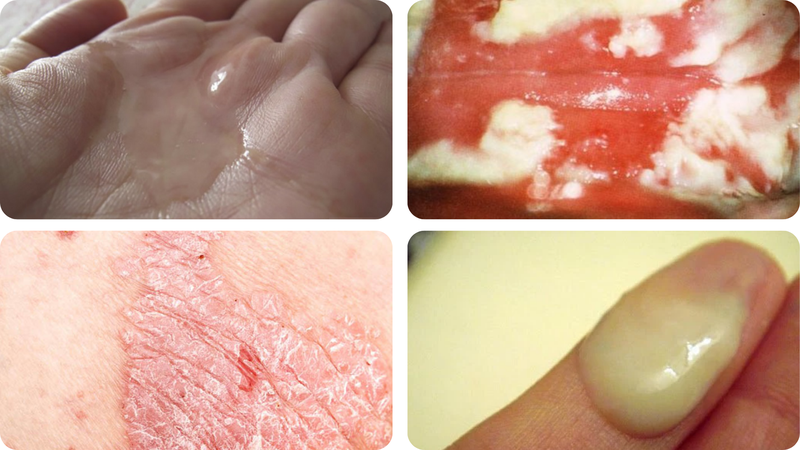 BỊ NẤM VÙNG KÍN: DẤU HIỆU VÀ NGUYÊN NHÂN 2 Bị nấm vùng kín có nguy hiểm không?