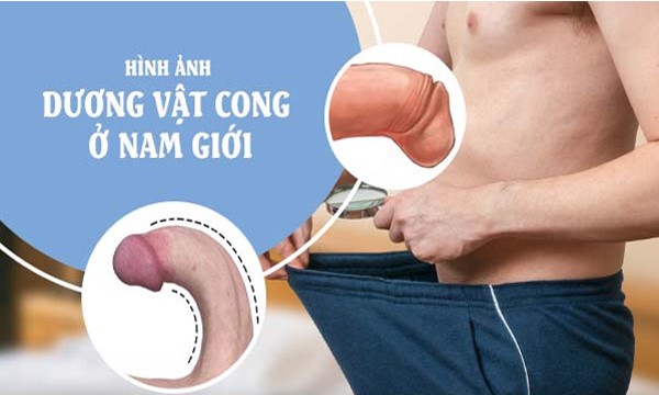 NHỮNG DẤU HIỆU DƯƠNG VẬT BẤT THƯỜNG CẦN LƯU Ý 3 Cong dương vật bất thường ở nam giới