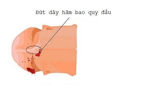 DƯƠNG VẬT CHẢY MÁU SAU KHI QUAN HỆ: NGUYÊN NHÂN, MỨC ĐỘ NGUY HIỂM VÀ CÁCH XỬ LÝ ĐÚNG 3 duong vat chay amsu sau khi quan he do rach day ham bao quy dau