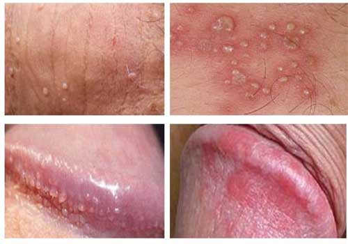 NỔI MỤN Ở DƯƠNG VẬT NGUY HIỂM KHÔNG? NGUYÊN NHÂN & CÁCH XỬ LÝ 1 dv noi mun