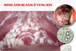 bi-nam-vung-kin