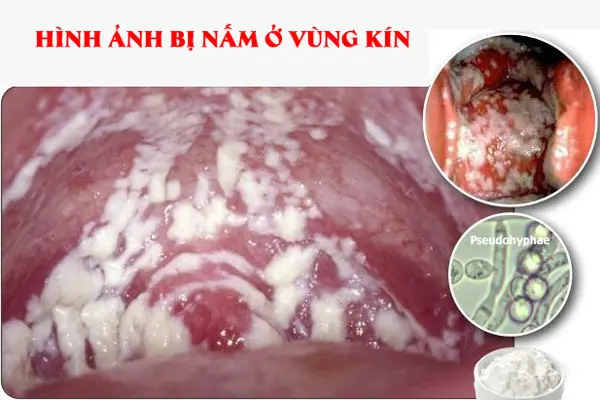 bi-nam-vung-kin