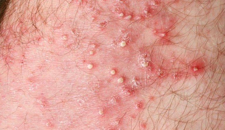 hinh anh viem nang long vung kin