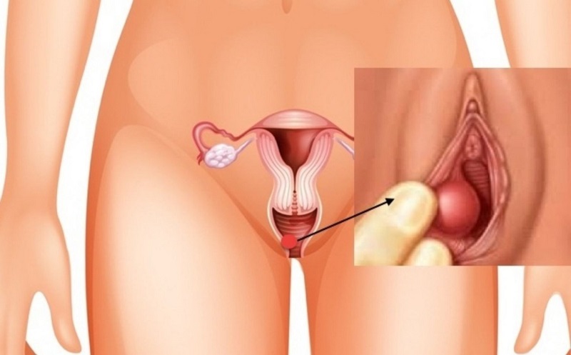 ÁP XE TUYẾN BARTHOLIN: NGUYÊN NHÂN VÀ CÁCH ĐIỀU TRỊ 1 ap xe tuyen bartholin 1