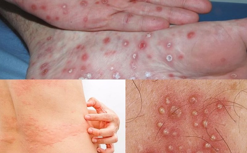 BỆNH XÃ HỘI Ở NỮ GIỚI NGUY HIỂM, THƯỜNG GẶP HÀNG NGÀY 3 Giang mai - Bệnh xã hội ở nữ giới nguy hiểm