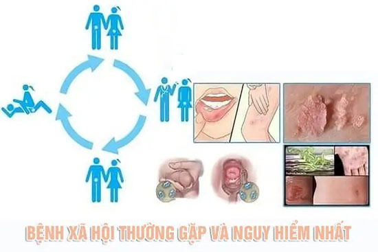 TƯ VẤN BỆNH XÃ HỘI TRỰC TUYẾN MIỄN PHÍ CÙNG BÁC SĨ GIỎI 1 cac benh xa hoi thuong gap