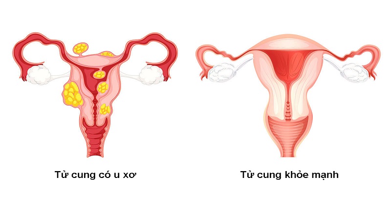 TẮC KINH NGUYỆT LÀ GÌ? NGUYÊN NHÂN VÀ CÁCH ĐIỀU TRỊ 3 U xơ cổ tử cung gây tắc kinh nguyệt