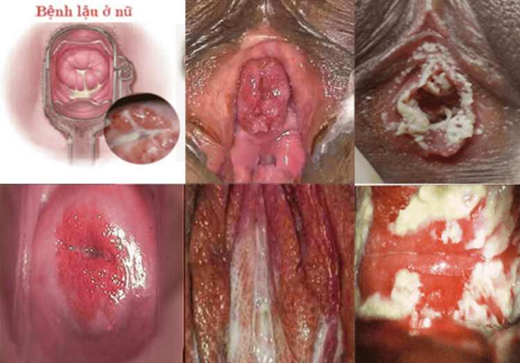 BỆNH XÃ HỘI Ở NỮ GIỚI NGUY HIỂM, THƯỜNG GẶP HÀNG NGÀY 6 Bệnh lậu ở nữ