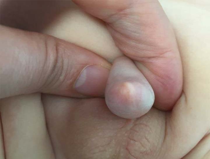 NONG BAO QUY ĐẦU: 7 ĐIỀU CHA MẸ CẦN BIẾT 3 nong bao quy dau bang tay