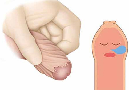 NONG BAO QUY ĐẦU: 7 ĐIỀU CHA MẸ CẦN BIẾT 1 nong bao quy dau la gi