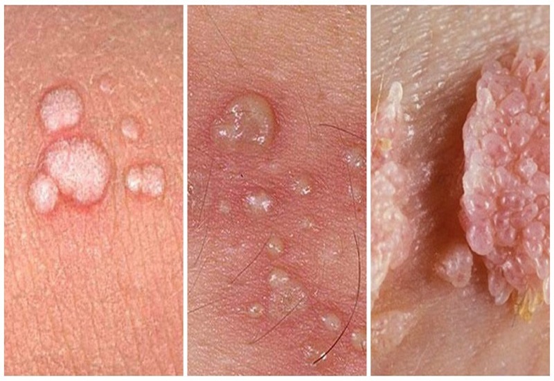 BỆNH XÃ HỘI Ở NỮ GIỚI NGUY HIỂM, THƯỜNG GẶP HÀNG NGÀY 4 Sùi mào gà - Bệnh xã hội ở nữ cần khám ngay