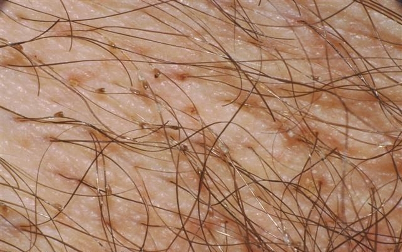 NGỨA MU VÙNG KÍN: NGUYÊN NHÂN VÀ CÁCH XỬ LÝ 2 ran mu vung kin