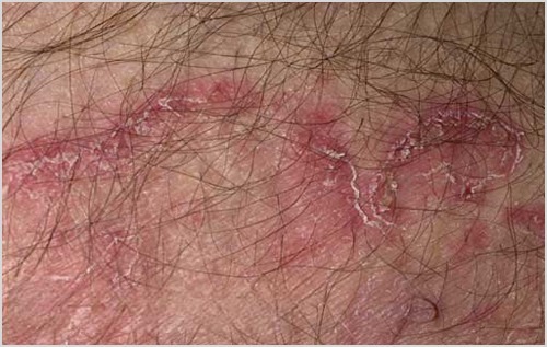 NGỨA MU VÙNG KÍN: NGUYÊN NHÂN VÀ CÁCH XỬ LÝ 3 vay nen gay ngua mu vung kin