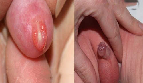 TRẺ NHỎ BỊ NỔI MẨN ĐỎ Ở BAO QUY ĐẦU CÓ ĐÁNG LO? 2 viem bao quy dau o tre nho