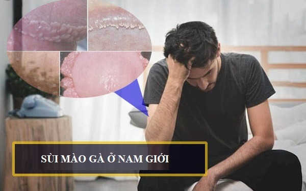 BỆNH SÙI MÀO GÀ Ở NAM - NGUYÊN NHÂN, DẤU HIỆU NHẬN BIẾT 4 benh sui mao ga o nam gioi