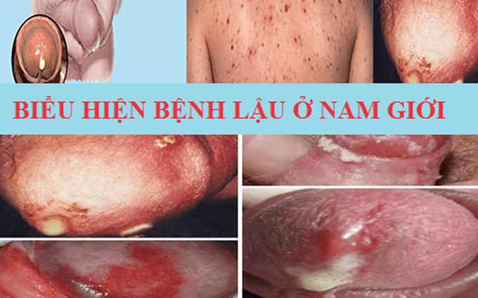 BỆNH LẬU Ở NAM VÀ NỮ CÓ TRIỆU CHỨNG KHÁC NHAU NHƯ THẾ NÀO? 2 Bệnh lậu ở nam giới
