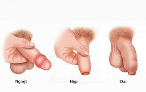 nghet bao quy dau la gi