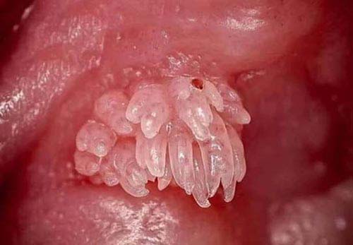 TRIỆU CHỨNG BỆNH SÙI MÀO GÀ Ở BỘ PHẬN SINH DỤC NỮ 3 Hình ảnh sùi mào gà ở nữ giới