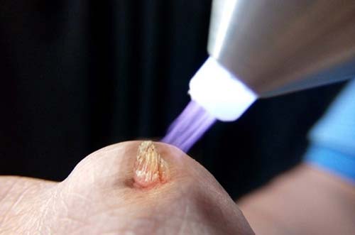 BỆNH SÙI MÀO GÀ CÓ CHỮA ĐƯỢC KHÔNG ? 4 66f61d85ab4c7f9465fad8ec 66f6186cfe6a1413bd46bb01 dot sui mao ga