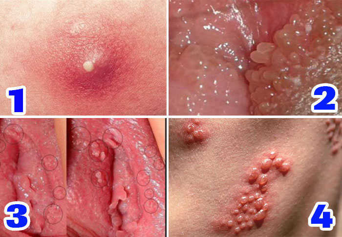 Mọc mụn ở vùng kín nữ