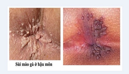SÙI MÀO GÀ Ở HẬU MÔN: NGUYÊN NHÂN, TRIỆU CHỨNG VÀ CÁCH ĐIỀU TRỊ 1 sui mao ga hau mon 2