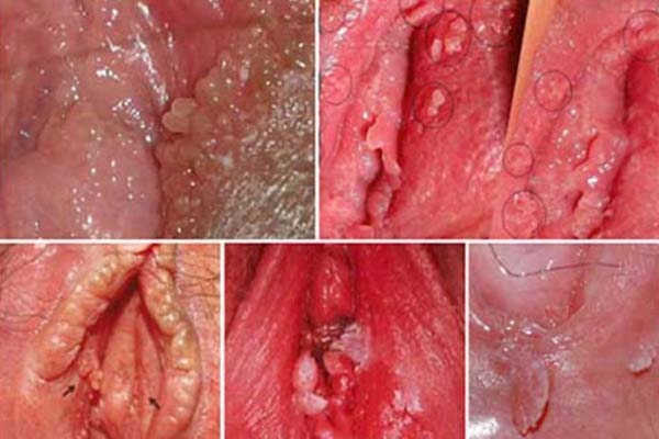 Bệnh sùi mào gà ở bộ phận sinh dục nữ