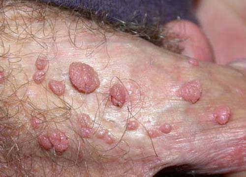 SÙI MÀO GÀ LÂY QUA ĐƯỜNG NÀO? CÁC CON ĐƯỜNG PHỔ BIẾN 3 sui mao ga o duong vat