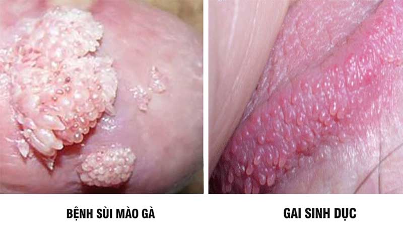 GAI SINH DỤC KHÁC SÙI MÀO GÀ NHƯ THẾ NÀO? DẤU HIỆU PHÂN BIỆT 1 sui mao ga va gai sinh duc