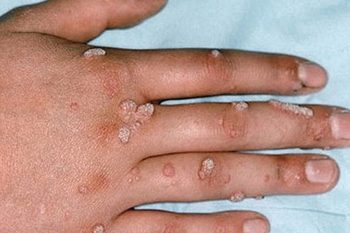 SÙI MÀO GÀ GIAI ĐOẠN ĐẦU: DẤU HIỆU & CÁCH XỬ LÝ HIỆU QUẢ 5 sui mao ga3 1