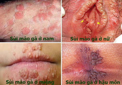 BỆNH SÙI MÀO GÀ CÓ CHỮA ĐƯỢC KHÔNG ? 1 Bệnh sùi mào gà có chữa được không?